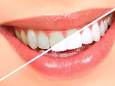 Teeth Whitening